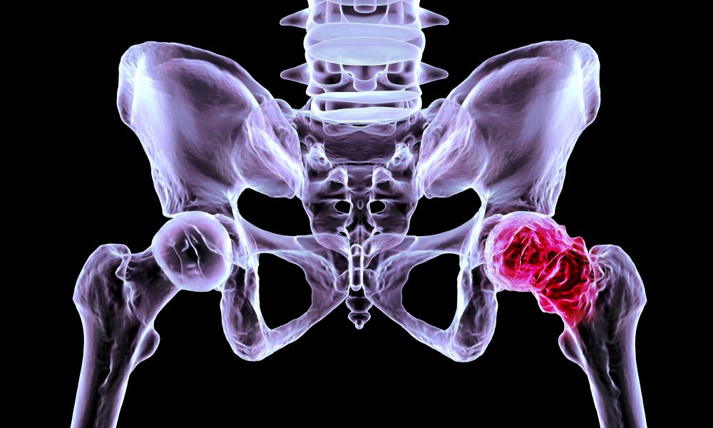 Pour ou contre le col du fémur ?
